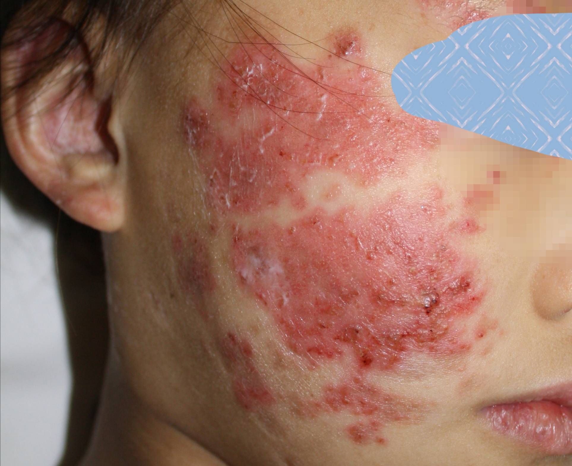 什么是系统性红斑狼疮 系统性红斑狼疮早期症状有哪些