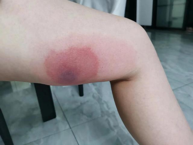 为什么小小蚊子会引发的骨痛热症?...