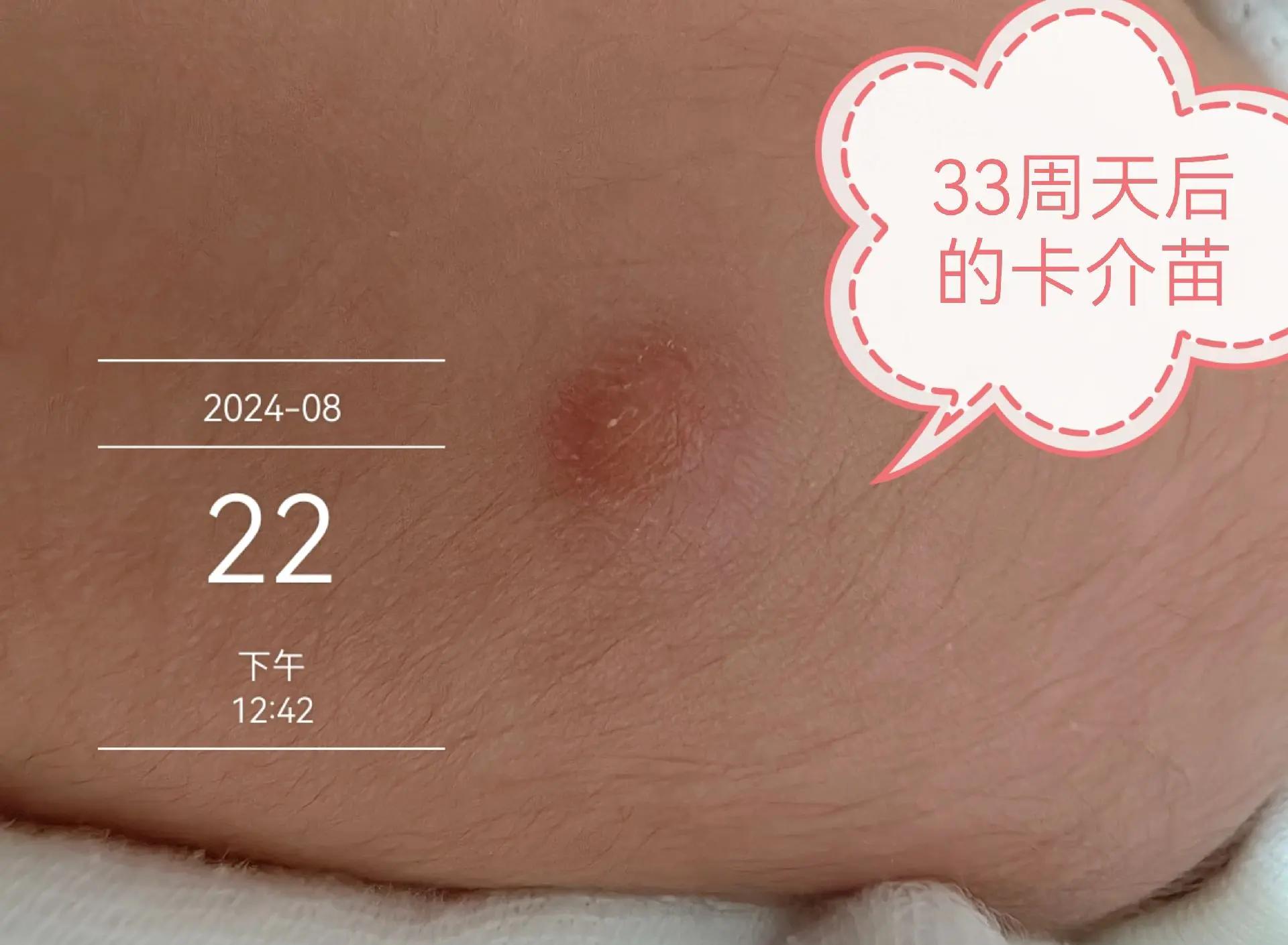 疫苗卡介苗的接种时长 疫苗接种证明在哪里补办