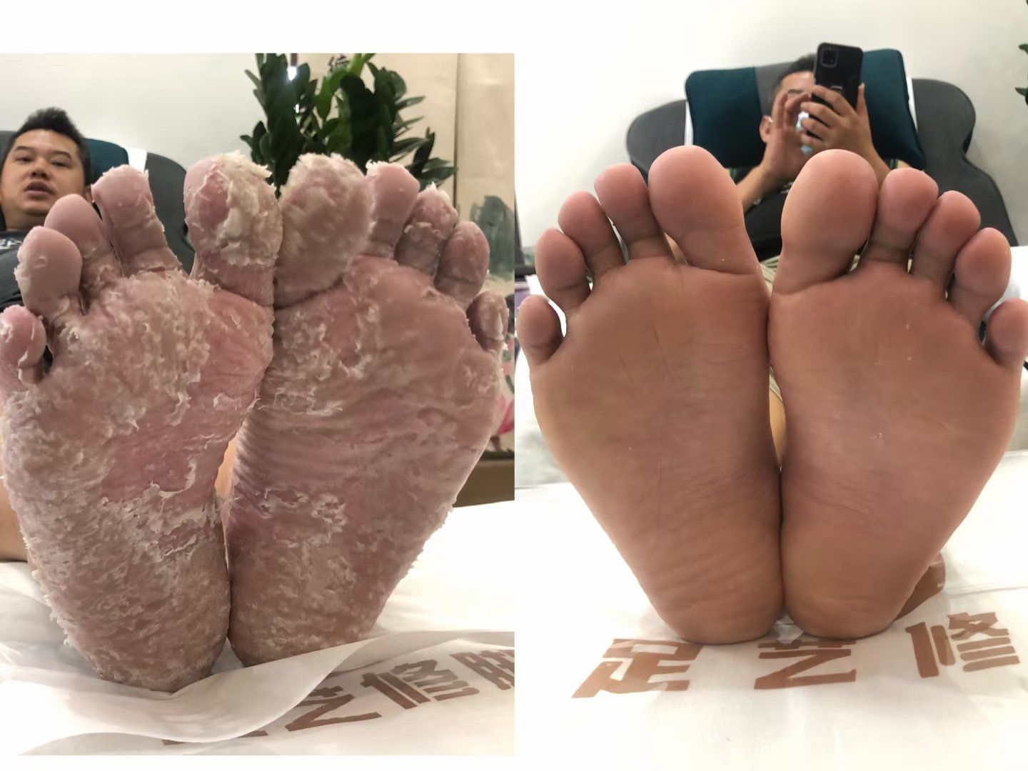 脚气怎么治疗能除根