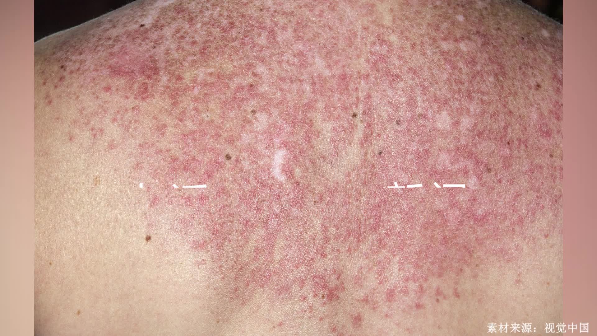 系统性红斑狼疮