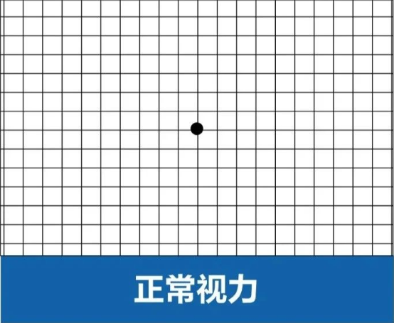 黄斑病变自查方法 如何预防老年性黄斑变性